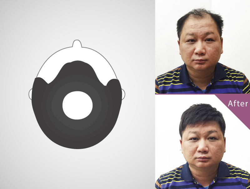 M+O shaped hair loss